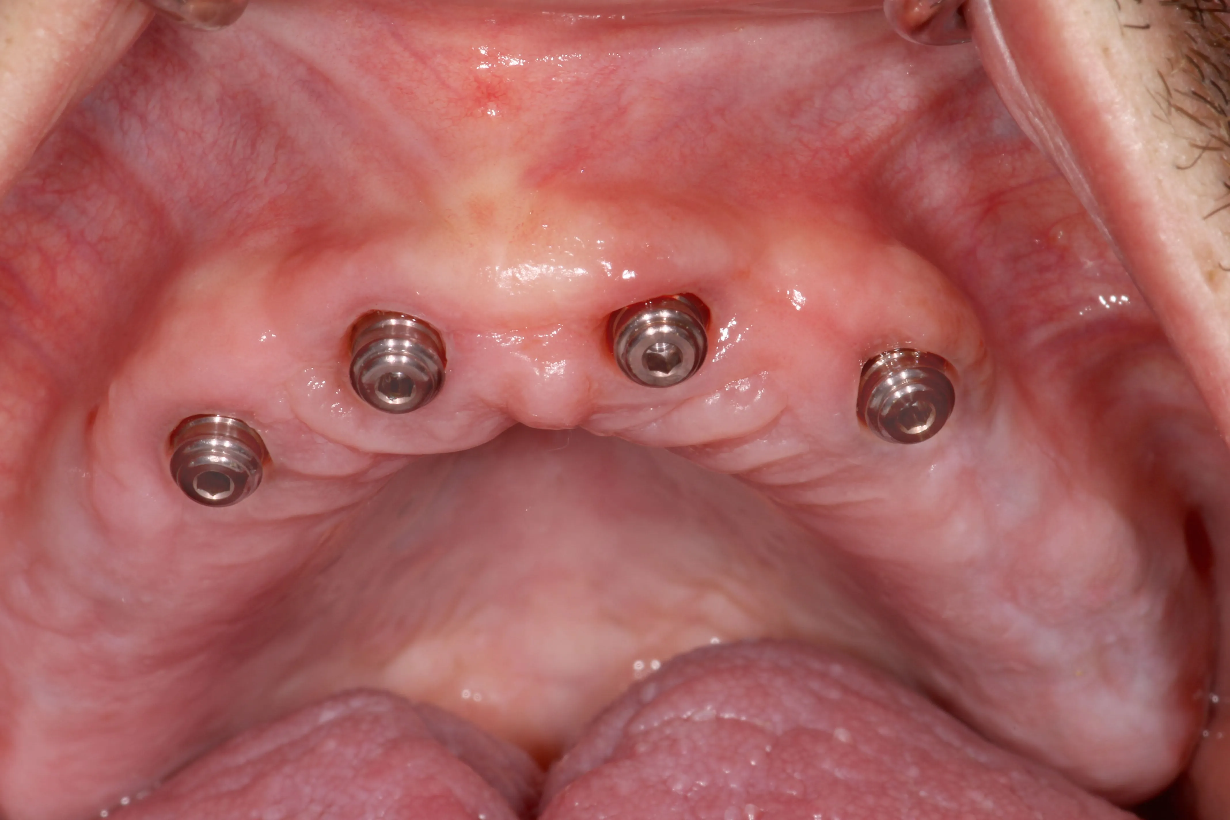 Effective and Practical Implant Overdentures